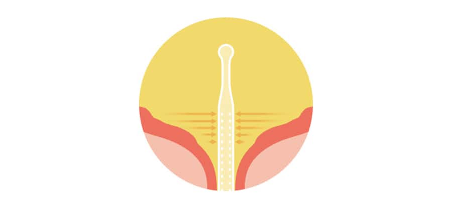 Diagram of a Luja catheter inside the bladder. Luja’s Micro-hole Zone Technology is designed to drain urine from the bottom of the bladder and enable an uninterrupted and free urine flow. 